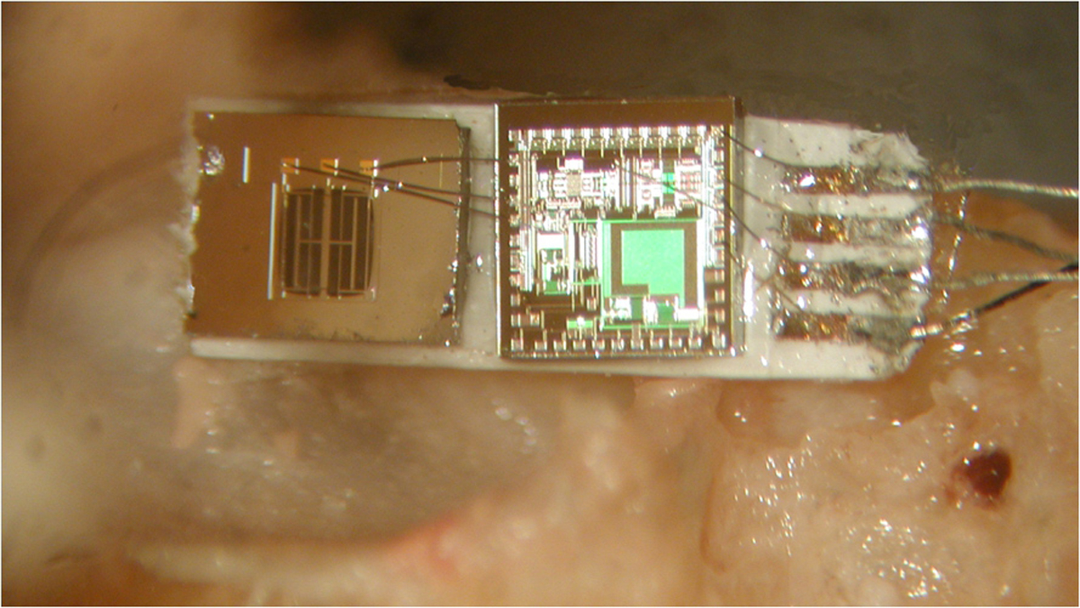 A new kind of tiny microphone is shown here attached at right to a cadaver’s umbo, where the eardrum (under left part of device) meets the hearing bones. The microphone includes an accelerometer and silicon chip that detect vibrations and convert them to electronic signals sent to electrodes in the inner ear’s cochlea, and from there to the brain. The device measures about one-tenth inch by one-quarter inch.